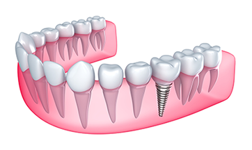 Dental Implants Plymouth, MI